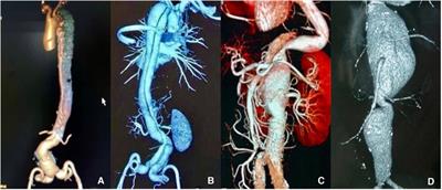 Debranching abdominal aortic hybrid surgery for aortic diseases involving the visceral arteries